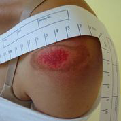 肩部创伤（冰刀划伤伤口）：1天